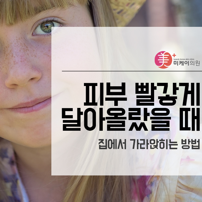 피부 빨갛게 달아올랐을 때 집에서 가라앉히는 방법 관련 이미지 1