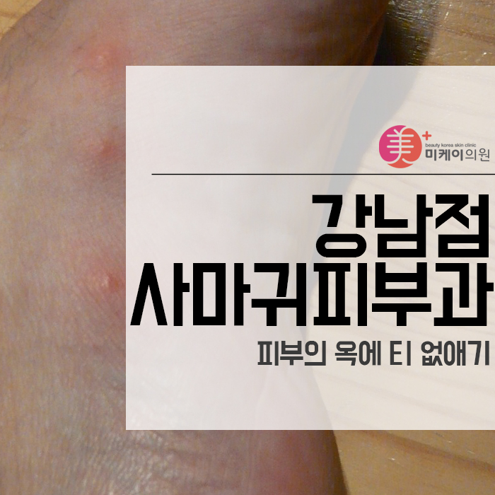 강남점사마귀피부과 피부의 옥에 티 없애기 관련 이미지 1