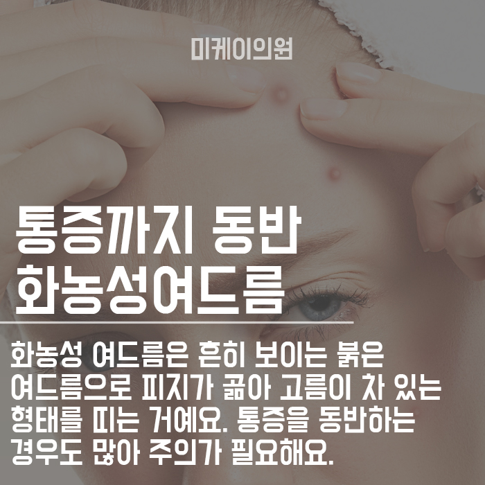 10대 화농성여드름흉터 의원에서 치료해야해요 관련 이미지 3