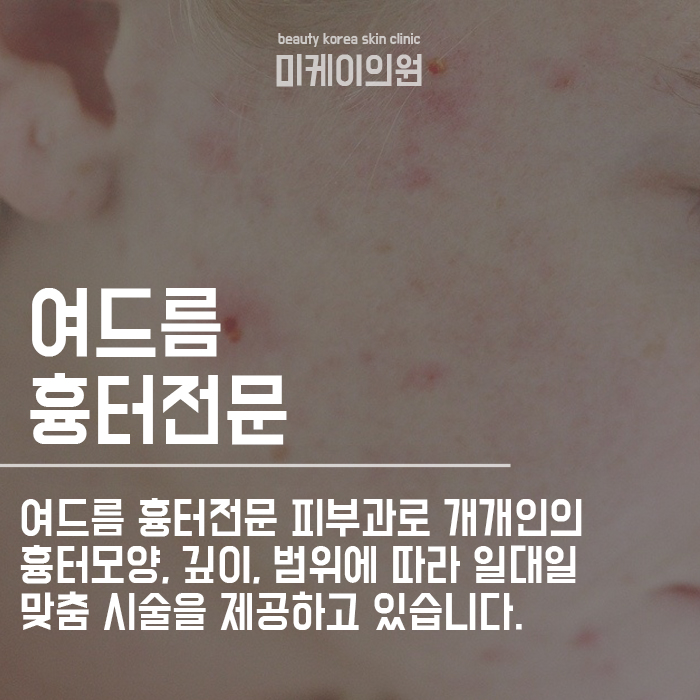 서초구 여드름흉터 걱정될때는 관련 이미지 6