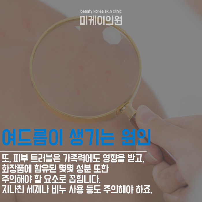 여드름관리 흉터와 붉은 자국까지 생각한다면 관련 이미지 2