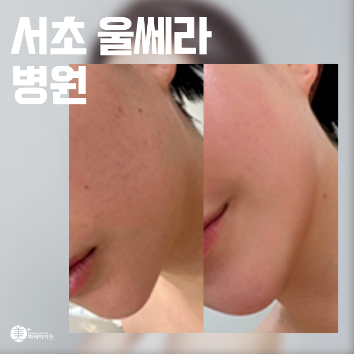 서초 울쎄라 병원 리프팅 시술의 원리와 효과 관련 이미지 1
