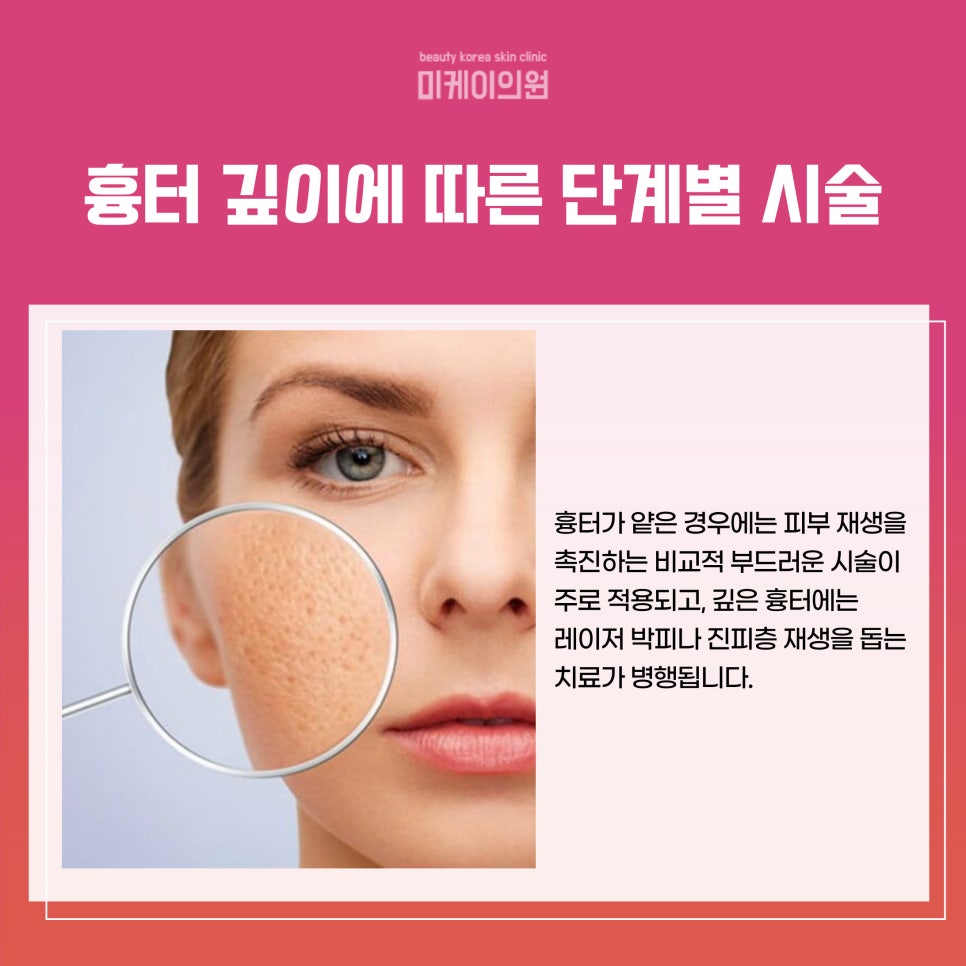 Regaining Confidence with Acne Scar Treatment in Seoul image 3