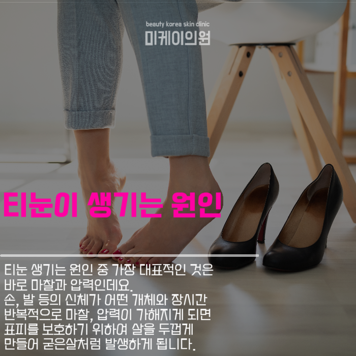 티눈생기는원인 및 케어법 알아보기 관련 이미지 2