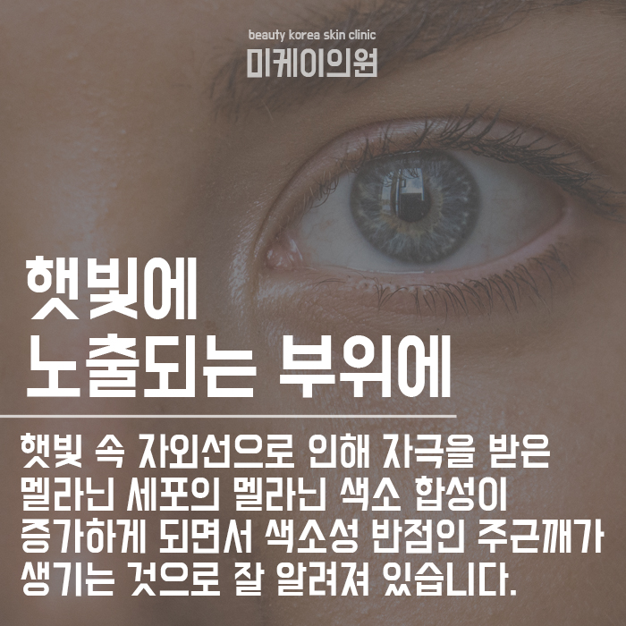서초구피부과 주근깨 생기는 이유 및 없애는 법 관련 이미지 4