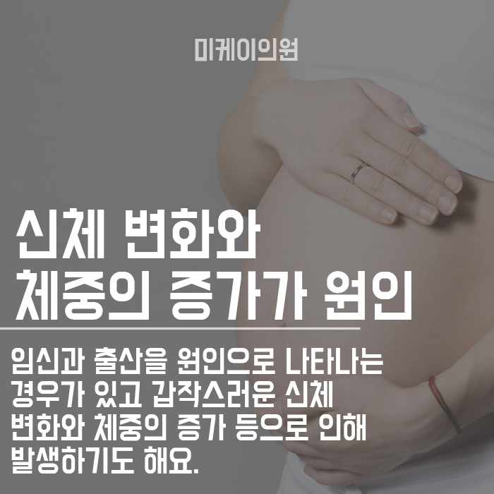 튼살관리방법 초기에 적극적으로 관련 이미지 3