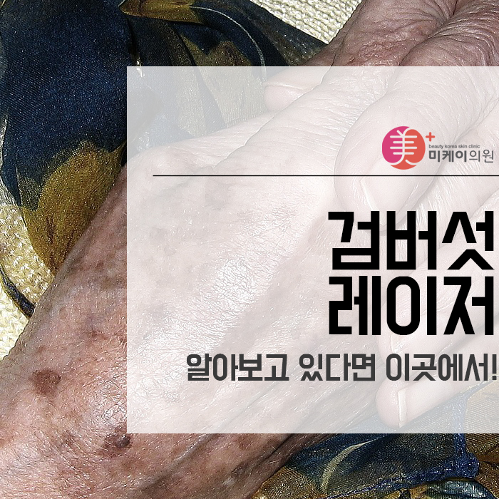 검버섯레이저 알아보고 있다면 이곳에서! 관련 이미지 1