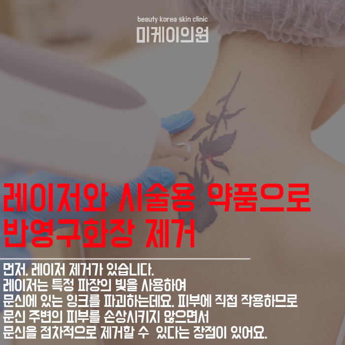 문신제거기간과 방법 알아보고 원하는 결과 얻기 관련 이미지 2