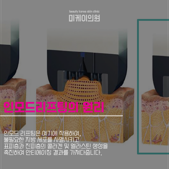 강남역 인모드리프팅 차별화된 특장점과 맞춤형 케어 관련 이미지 3