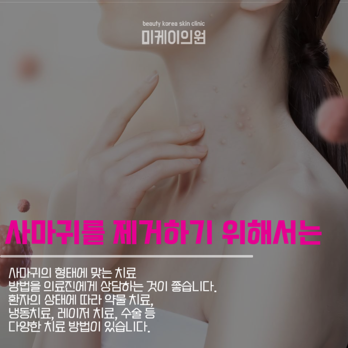 서초사마귀 고민되신다면 미케이로 관련 이미지 4
