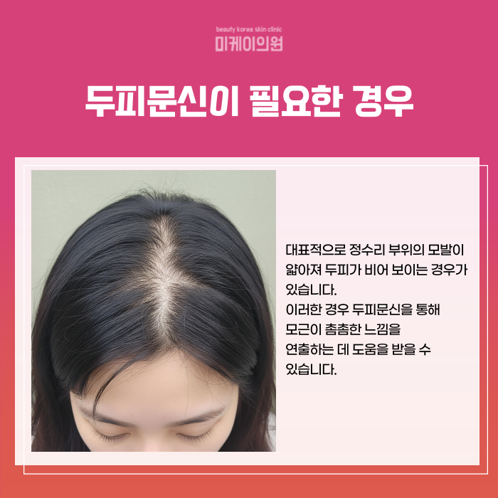 서초 두피문신 잘하는곳 티 안나게 관련 이미지 3