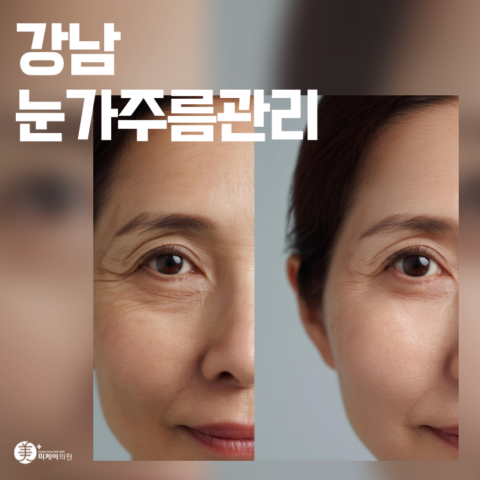 강남 눈가주름관리 아이슈링크와 주름보톡스로 해결 관련 이미지 1