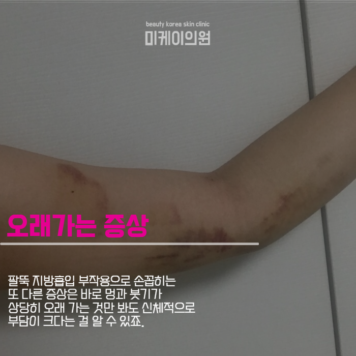 팔뚝 지방흡입 부작용 걱정될 때는 관련 이미지 3
