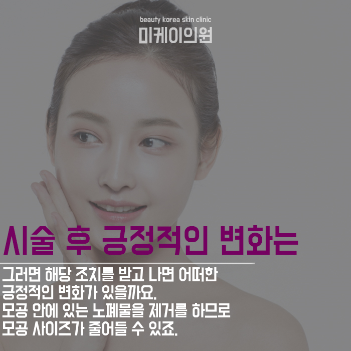 블랙헤드아쿠아필 특징 알아보자 관련 이미지 5