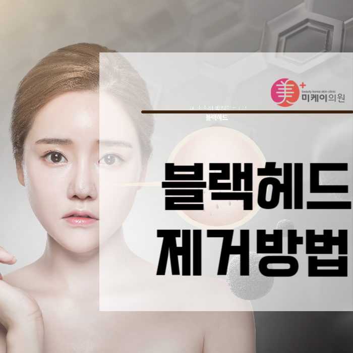 블랙헤드제거방법 자극을 줄이려면 관련 이미지 1