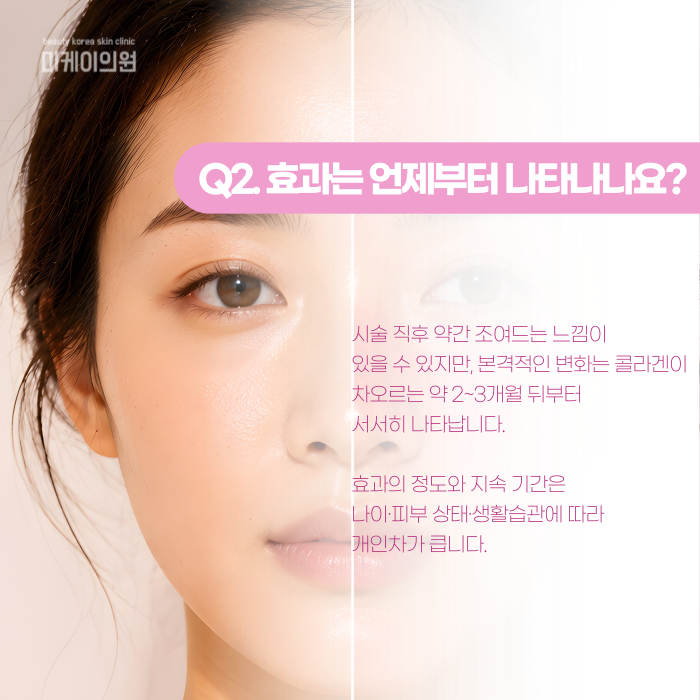 Gangnam Ultherapy Lifting: When Do the Effects Start to Show? image 3