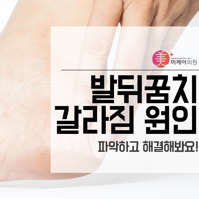 발뒤꿈치 갈라짐 원인 파악하고 해결해봐요! 관련 이미지 1