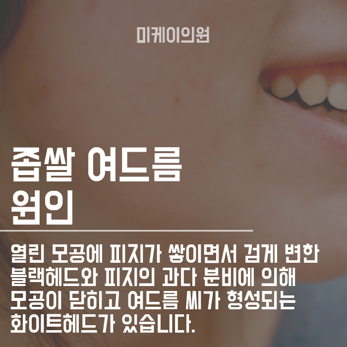 면포성여드름 초기관리 늦지 않게 관리해야 합니다. 관련 이미지 2