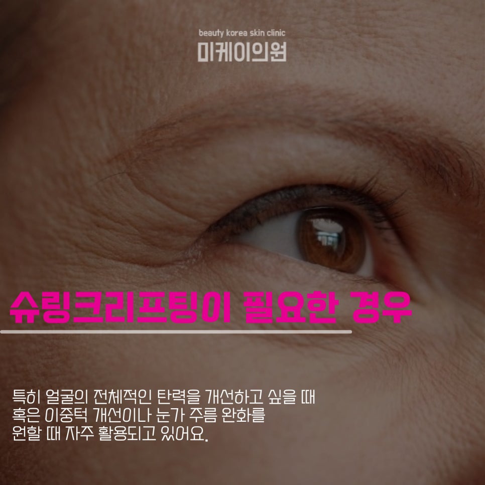 If You’re Searching for the Price of Shurink Lifting in Gangnam image 3