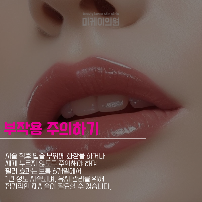 강남역 입술필러 매력적인 인상 만들기 관련 이미지 5