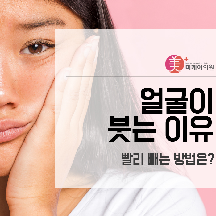 얼굴이 붓는 이유 붓기 빨리 빼는 방법은? 관련 이미지 1