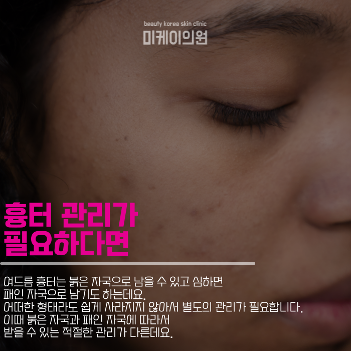 강남역여드름 본격적으로 관리하자 관련 이미지 5