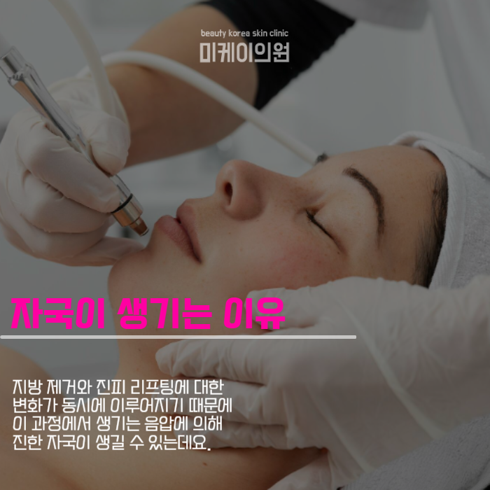인모드 멍 기간 걱정으로 시작 못했다면 관련 이미지 4