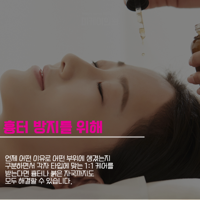 여드름 압출 방법 상처 생기지 않도록 관련 이미지 5
