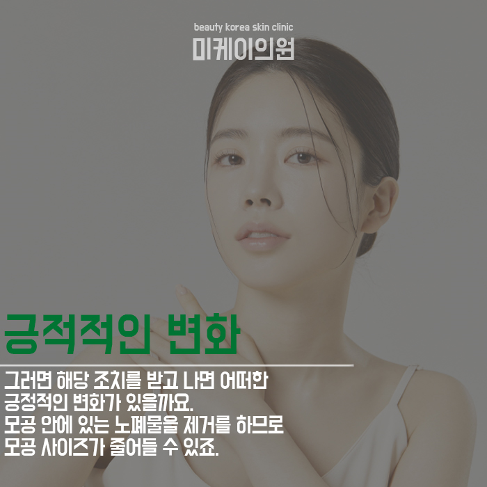 블랙헤드아쿠아필 특징 알아보자 관련 이미지 5