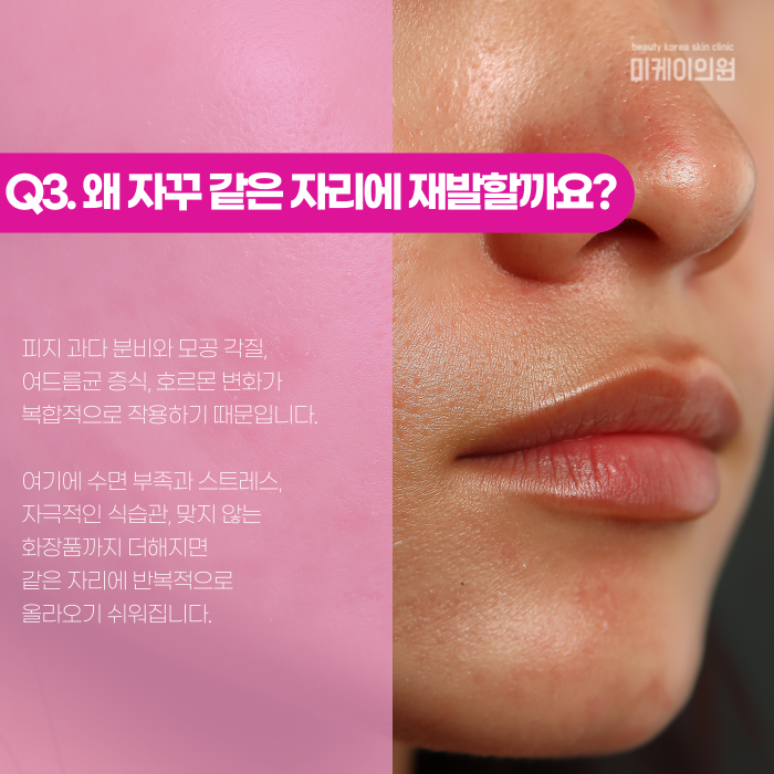 강남 여드름 피부과, 언제부터 가야 할까? 관련 이미지 4