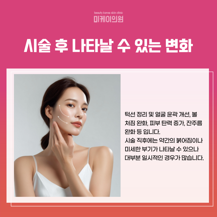 서초 울쎄라 병원 리프팅 시술의 원리와 효과 관련 이미지 5
