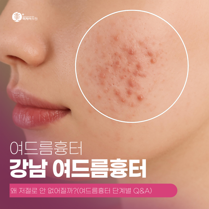 Why Don’t Gangnam Acne Scars Disappear on Their Own? image 1