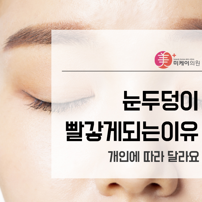 눈두덩이빨갛게되는이유 개인에 따라 달라요 관련 이미지 1