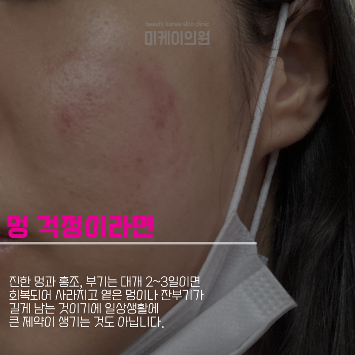 인모드fx 시술주기 맞춰야 하니까 관련 이미지 5