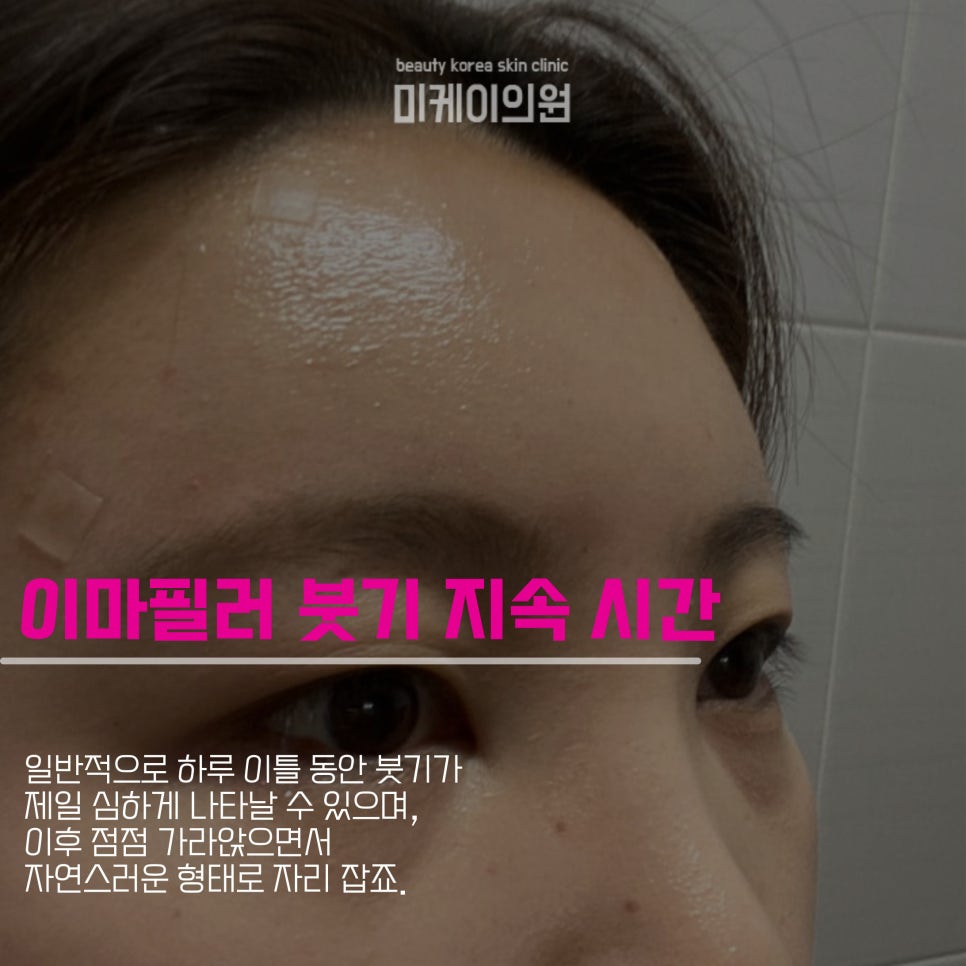 What Causes Swelling After Forehead Filler and How to Reduce It image 3