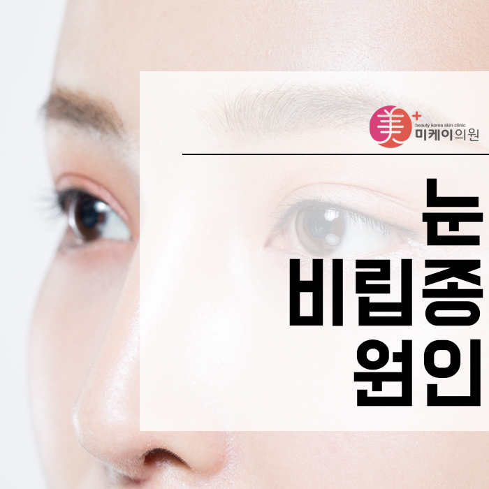 눈비립종원인 및 관리 방법 알아보자 관련 이미지 1