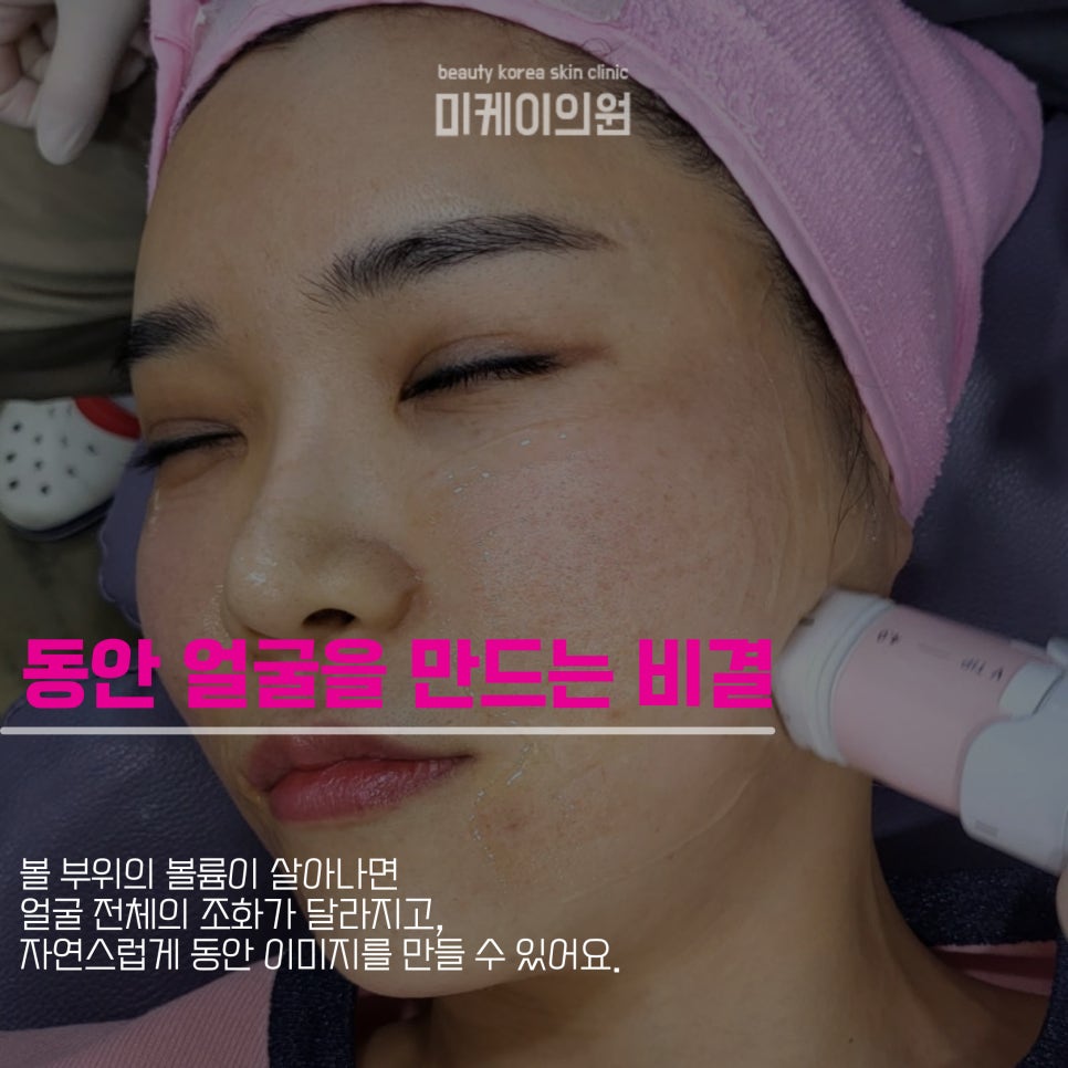 강남역 볼뉴머 리프팅으로 자연스러운 볼륨을 관련 이미지 2