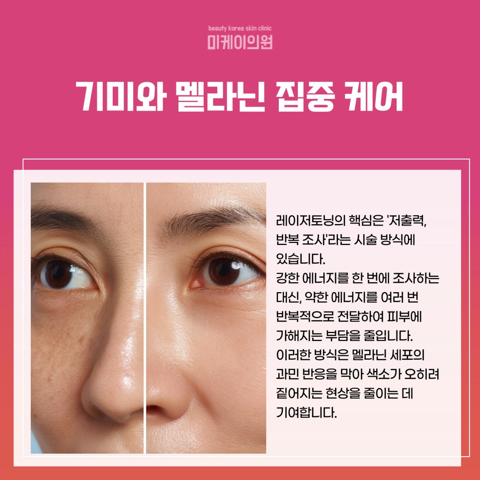 Let’s Find Out the Secret of Laser Toning in Seocho-gu image 2