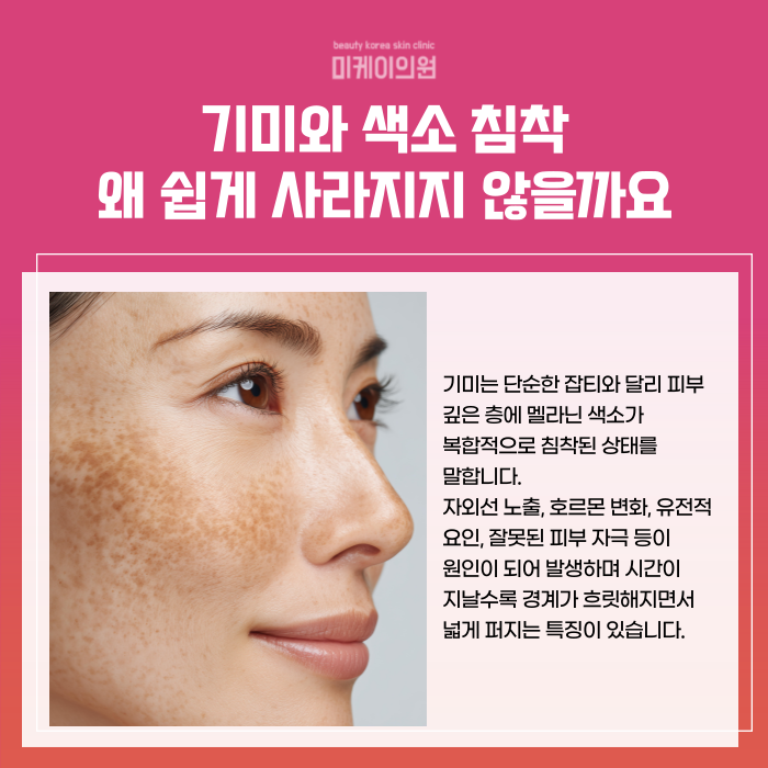 강남역 레이저토닝 기미제거 토닝의 이해 관련 이미지 2