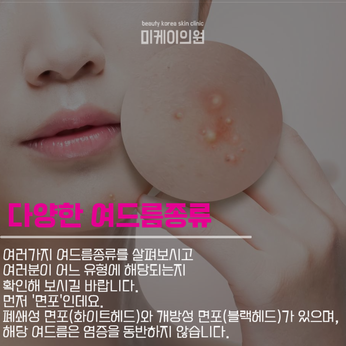 여드름종류 및 관리방법 살펴보기 관련 이미지 3