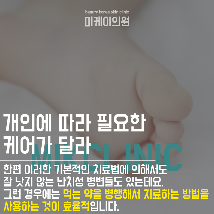 발바닥 티눈 원인 초기에 관리를 시작해요 관련 이미지 4