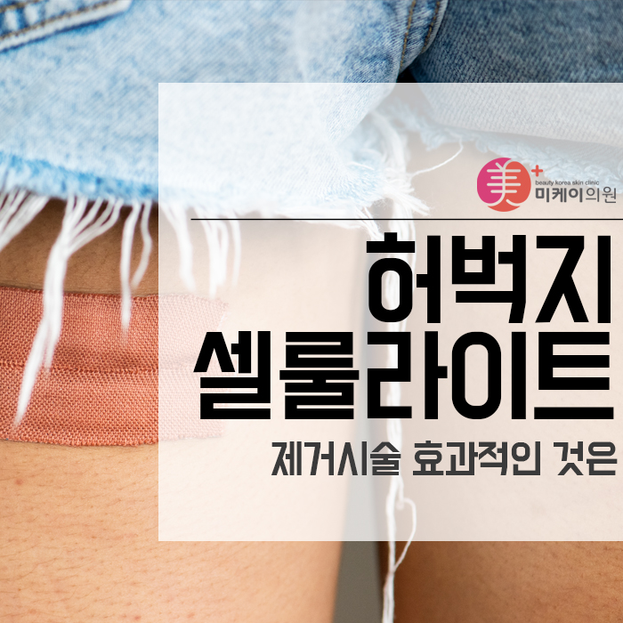 허벅지 셀룰라이트 제거시술 효과적인 것은 관련 이미지 1