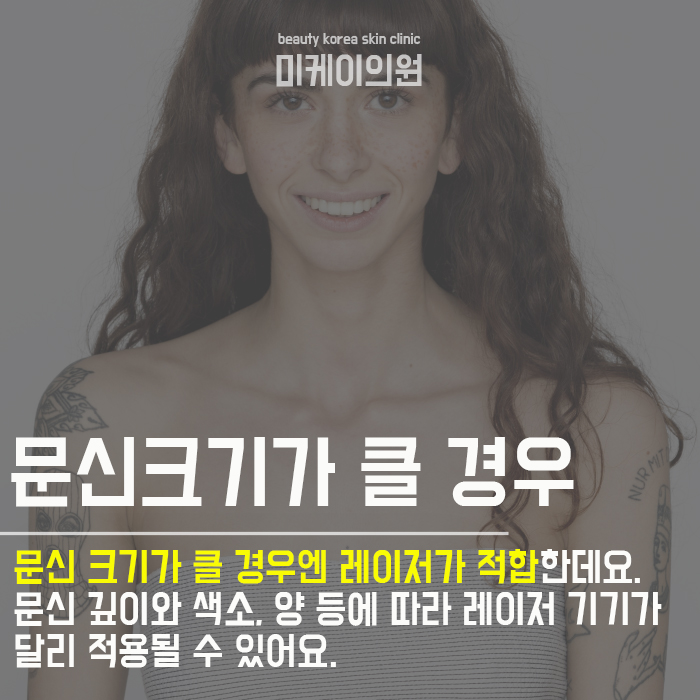 문신제거치료기간 미리 고려해요 관련 이미지 2