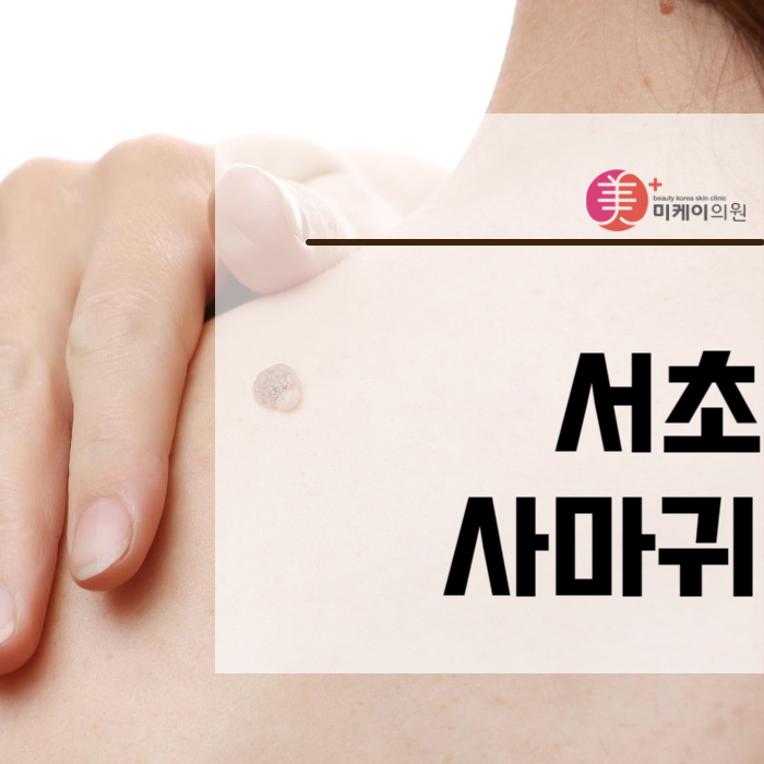 서초사마귀 고민되신다면 미케이로 관련 이미지 1