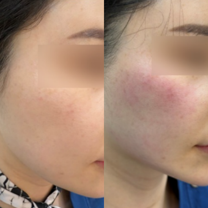 Seocho Onda Lifting: If Line Care Is Urgent image 7
