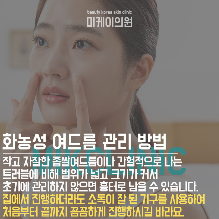 여드름압출관리방법 이것만큼은 꼭 지키세요! 관련 이미지 3