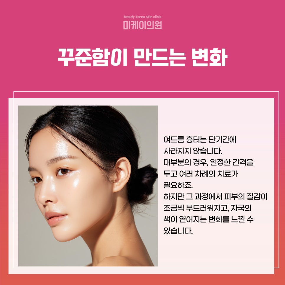 Acne Scar Treatment at a Dermatology Clinic in Seocho-gu image 4
