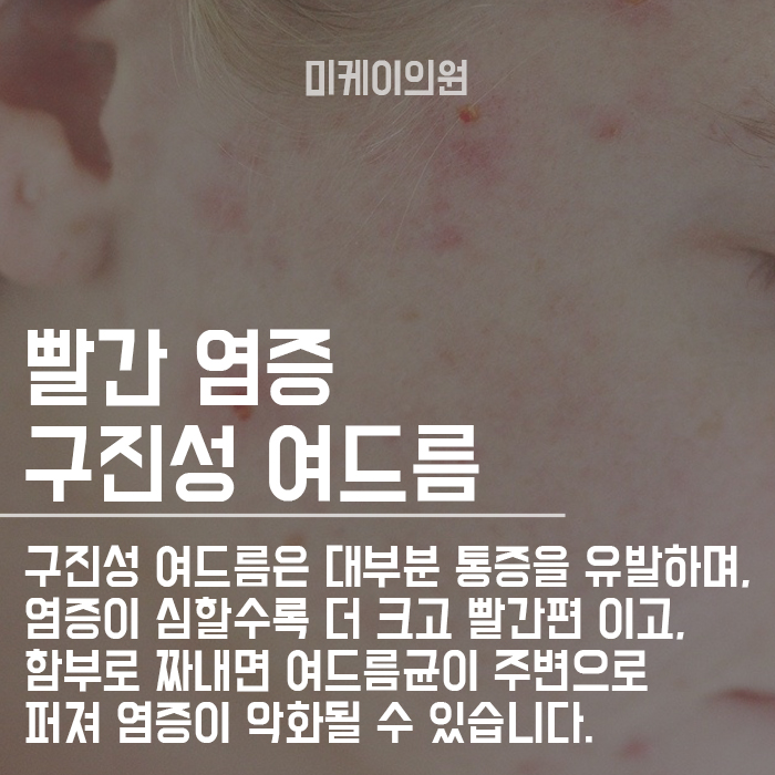 강남여드름피부과 깨끗한 피부를 갖고 싶다면 관련 이미지 3
