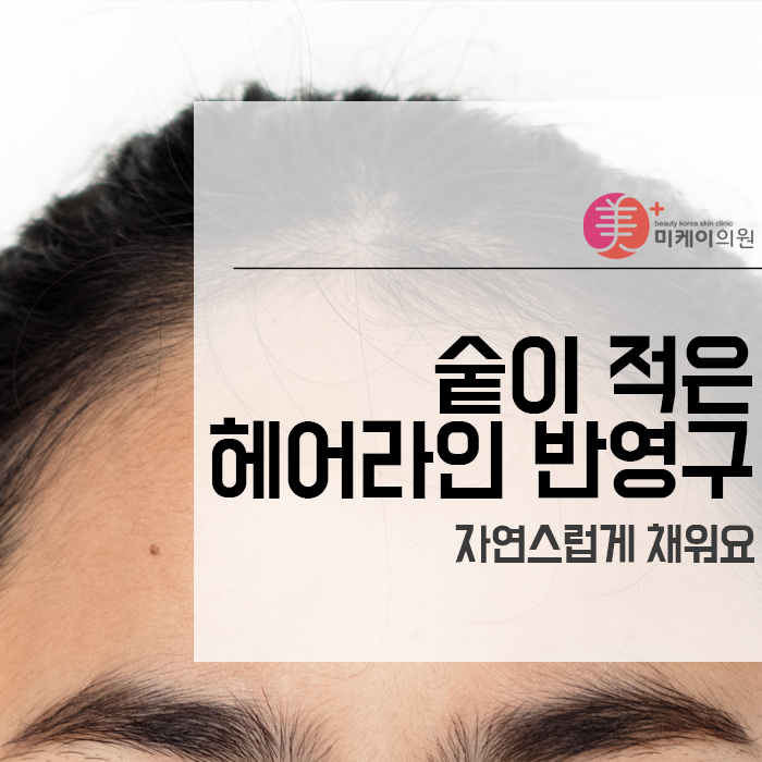 숱이 적은 헤어라인 반영구 자연스럽게 채워요 관련 이미지 1