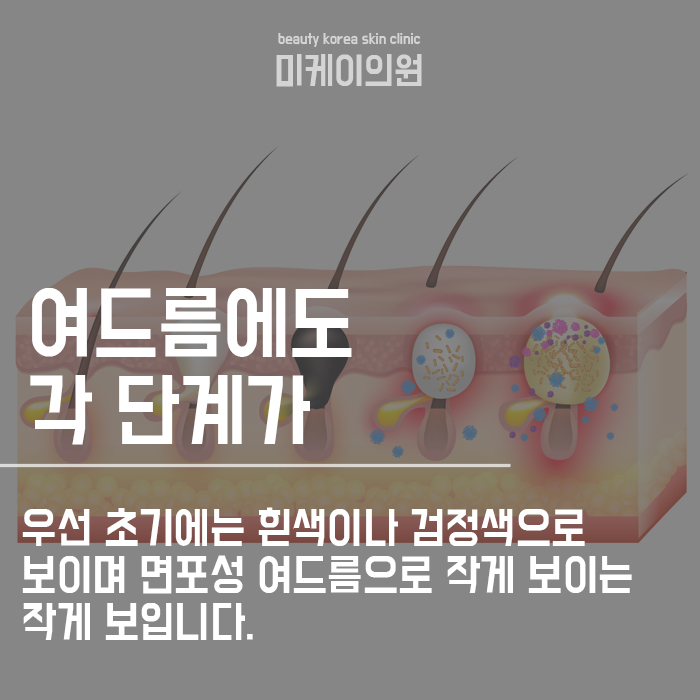 강남성인여드름 고민하지말고 관련 이미지 2